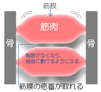 筋膜療法　筋膜リリース　癒着リリース　筋膜 メディセル筋膜療法 | みやこスポーツ整骨院