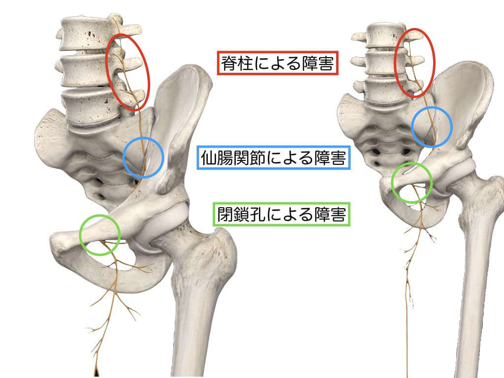 内ももが張る 坐骨神経ではなく 閉鎖神経による障害 ブログ アギトス鍼灸整骨院