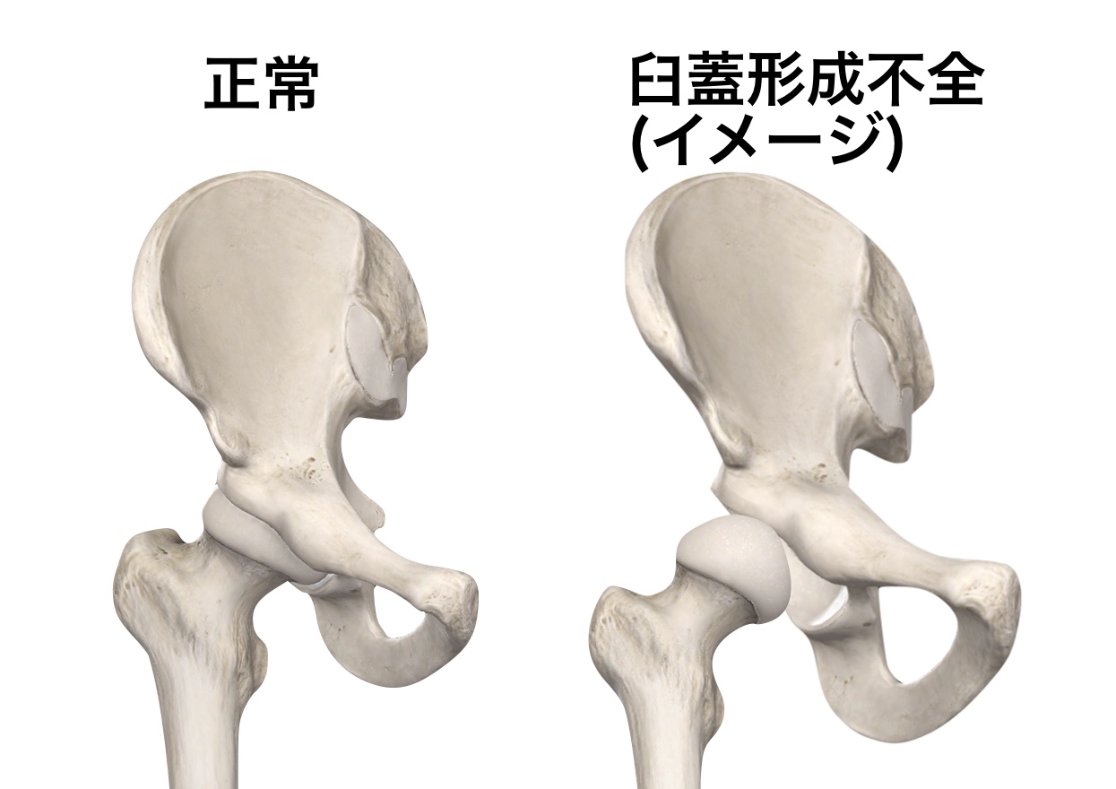 臼 蓋 形成 不全