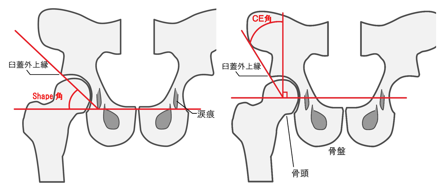 臼蓋形成不全について | ブログ | アギトス鍼灸整骨院