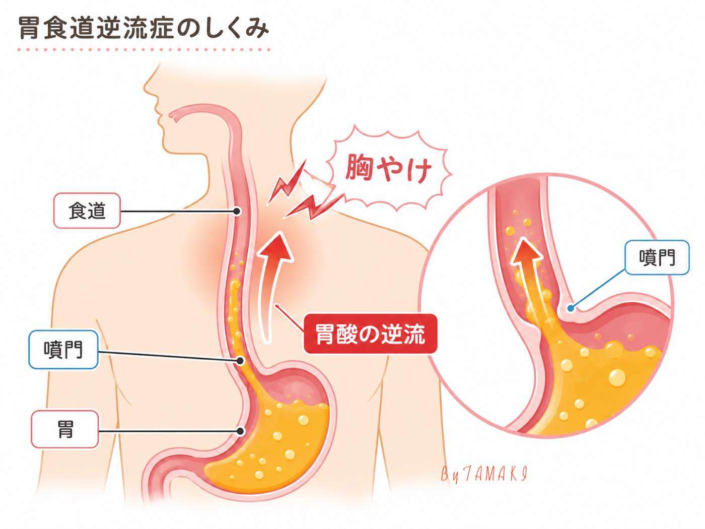 胸焼け の 原因