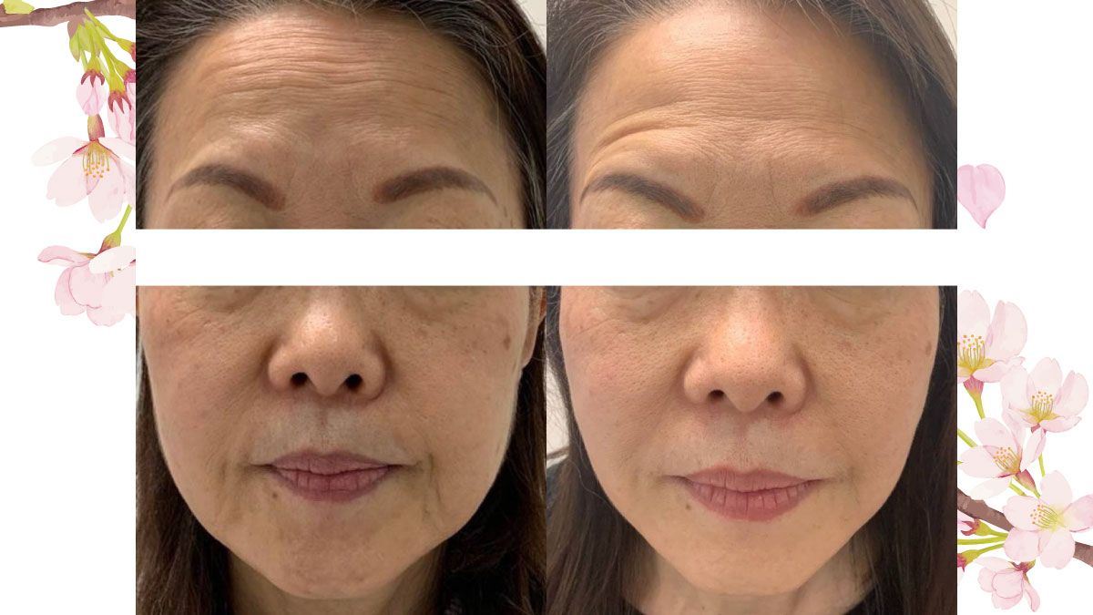 厚木市のフェイシャルエステ│シミケア専門店SAKURA