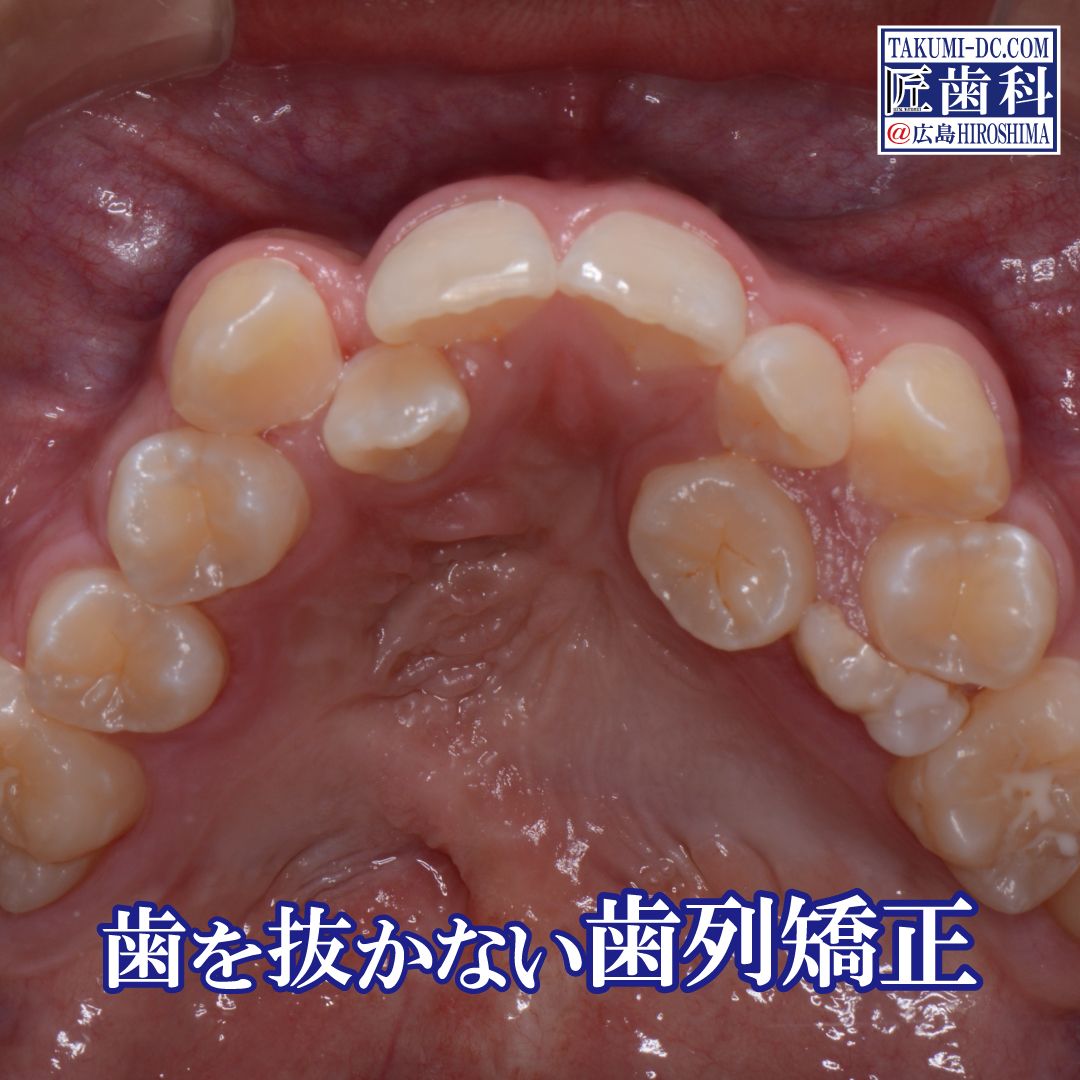 歯列矯正』症例11 (受け口 / 骨格性の反対咬合) | 『匠歯科・矯正